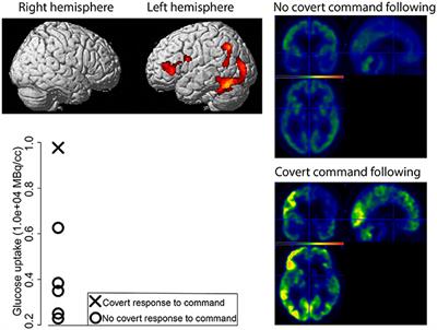 BCI Performance and Brain Metabolism Profile in Severely Brain-Injured Patients Without Response to Command at Bedside